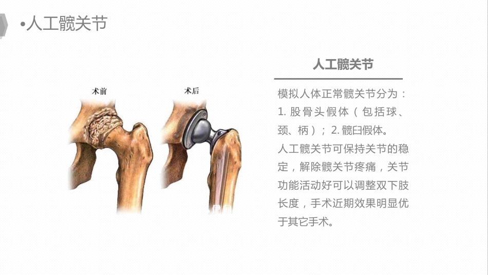 外科护理：换人工髋关节预防深静脉血栓护理_第7页