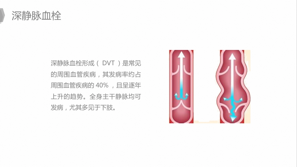 外科护理：换人工髋关节预防深静脉血栓护理_第8页