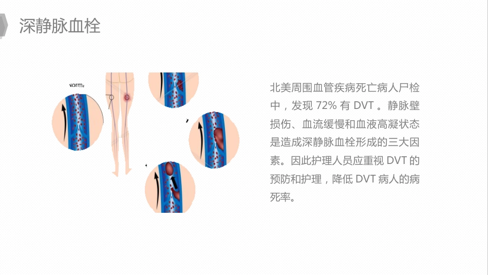 外科护理：换人工髋关节预防深静脉血栓护理_第9页
