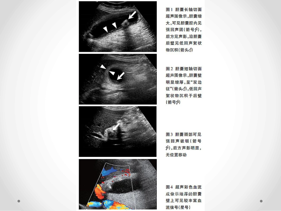 胆囊炎和胆石症-PPT课件_第6页