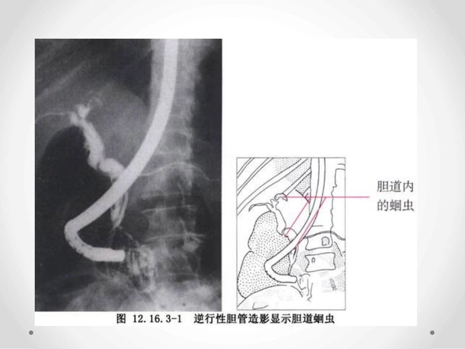 胆囊炎和胆石症-PPT课件_第8页