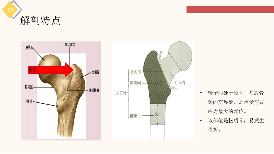 股骨粗隆间骨折的护理查房_第6页