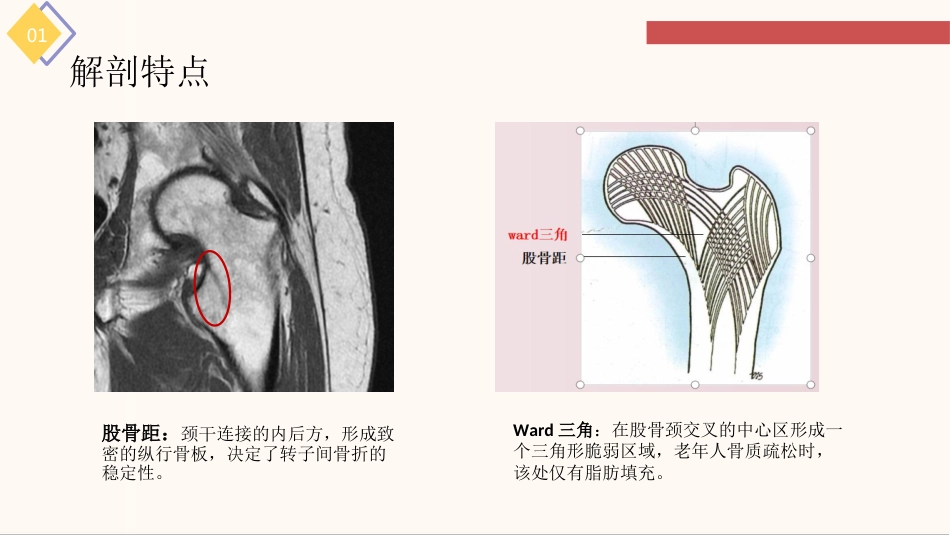 股骨粗隆间骨折的护理查房_第8页
