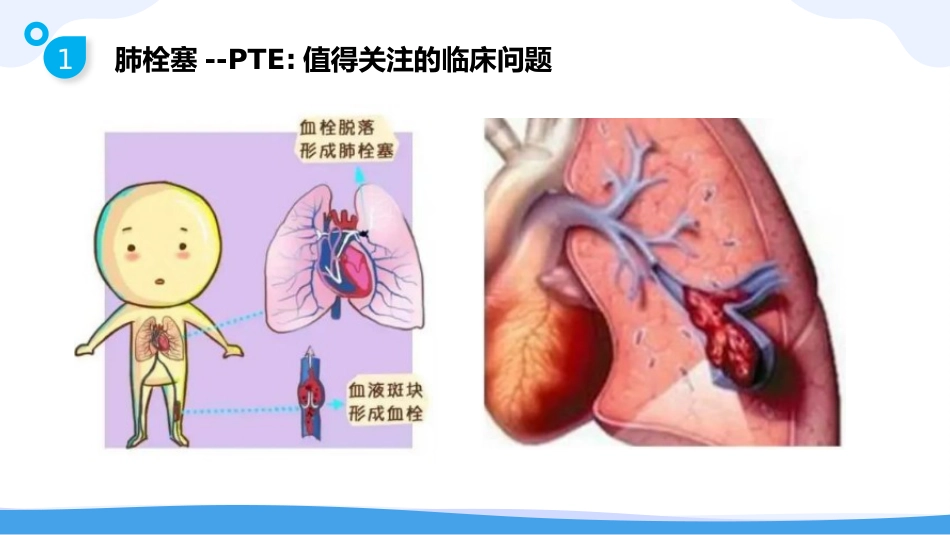 静脉血栓栓塞症(VTE)的-预防与护理_第9页