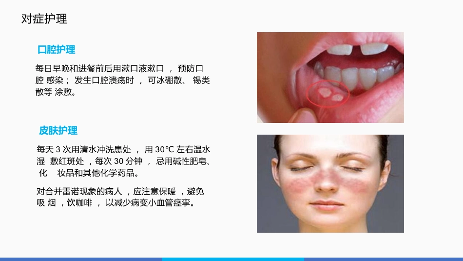 系统性红斑狼疮的护理PPT_第12页