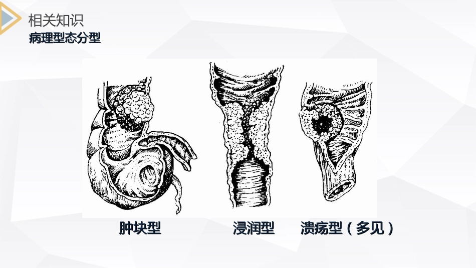 外科护理：结肠癌直肠癌护理_第11页
