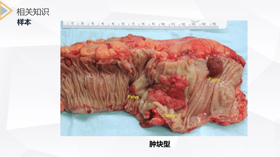 外科护理：结肠癌直肠癌护理_第12页