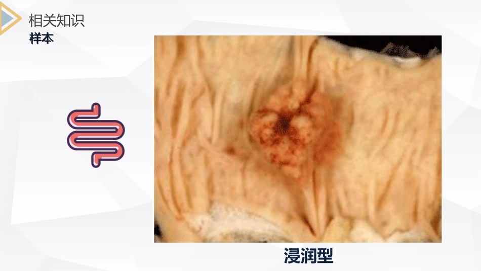 外科护理：结肠癌直肠癌护理_第13页