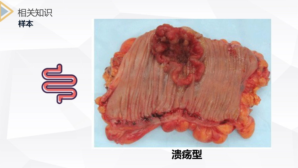 外科护理：结肠癌直肠癌护理_第14页