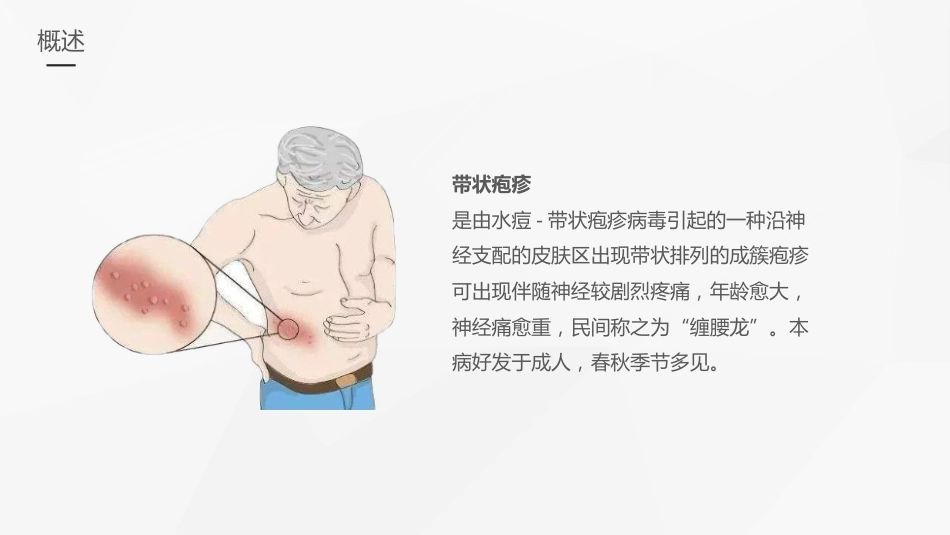 外科护理：带状疱疹后遗神经痛护理_第4页