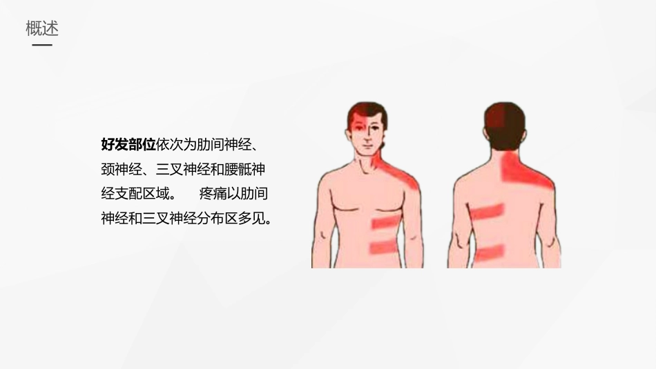 外科护理：带状疱疹后遗神经痛护理_第5页
