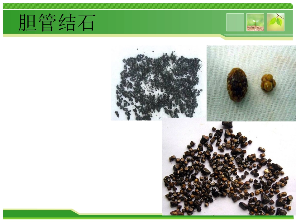 外科护理：胆总管结石护理查房_第8页