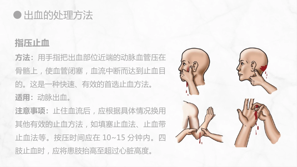外科护理：出血的观察和护理_第13页