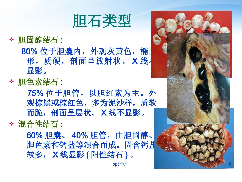 胆囊炎胆囊结石病人护理_第6页