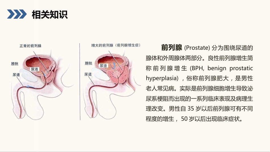 外科护理：前列腺增生护理查房知识课件_第4页