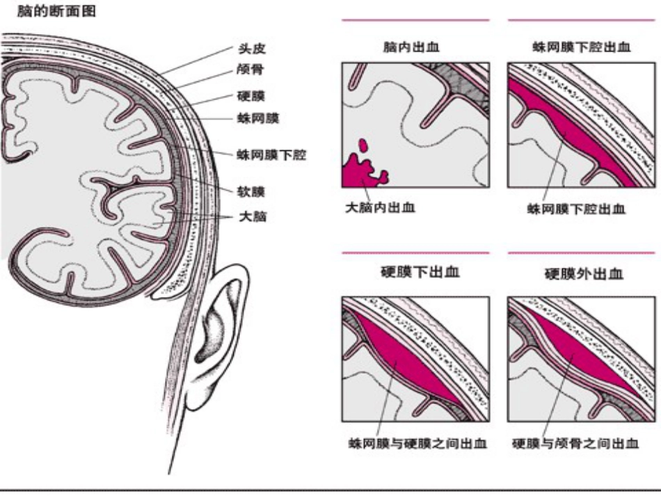 新生儿颅内出血_第8页