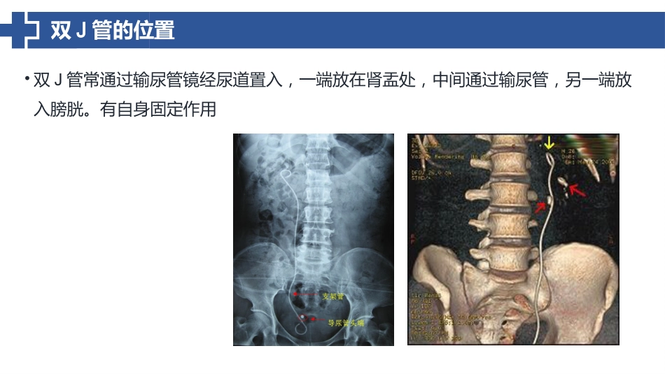 双J管置入术后护理_第12页