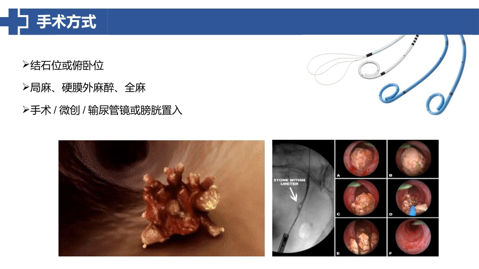 双J管置入术后护理_第13页