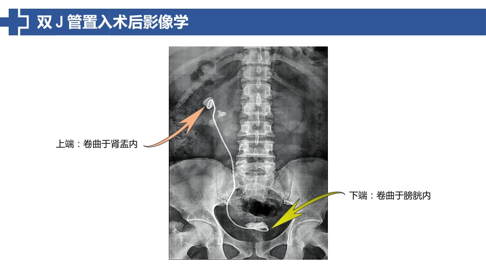 双J管置入术后护理_第14页