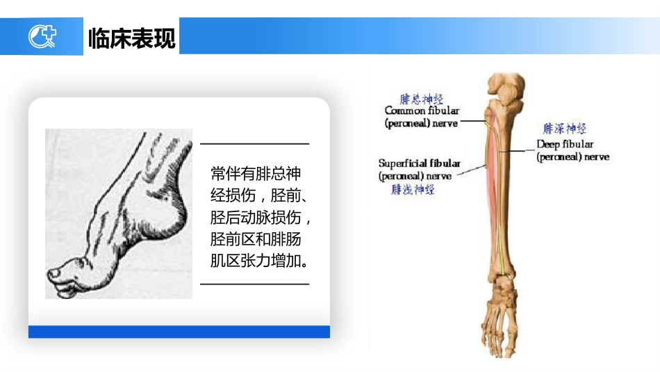 外科护理：胫腓骨骨折护理_第10页