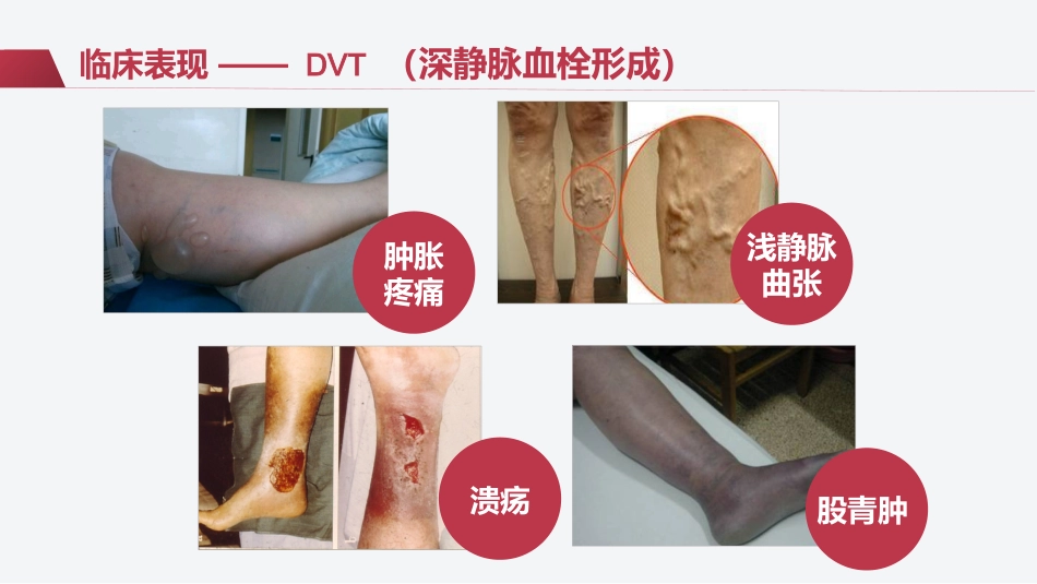 VTE的预防及护理措施(静脉血栓栓塞症相关知识)_第10页