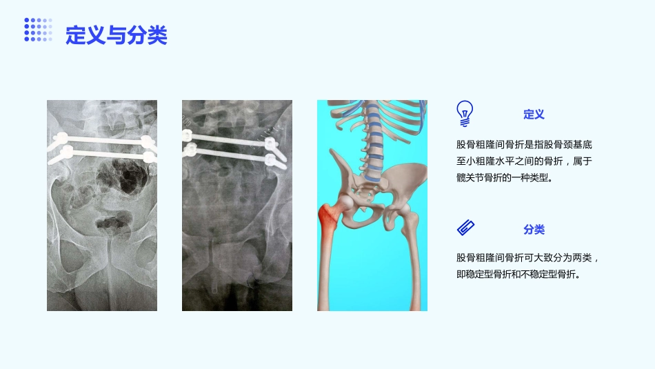 股骨粗隆间骨折护理ppt课件_第4页