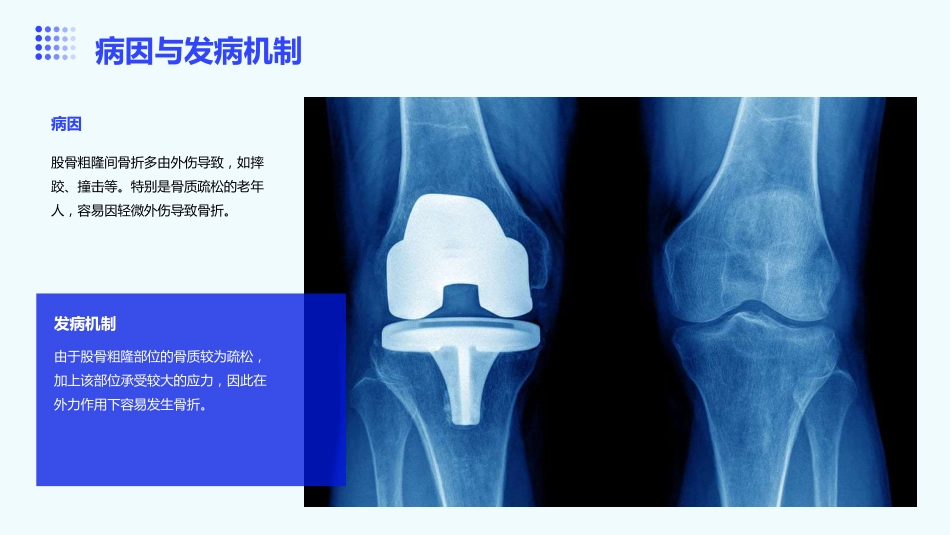 股骨粗隆间骨折护理ppt课件_第5页