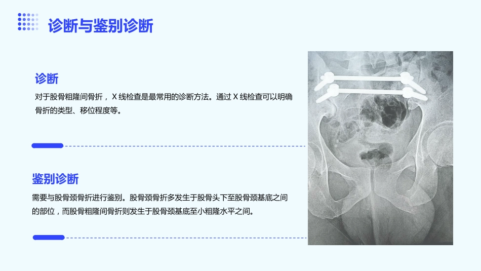 股骨粗隆间骨折护理ppt课件_第6页