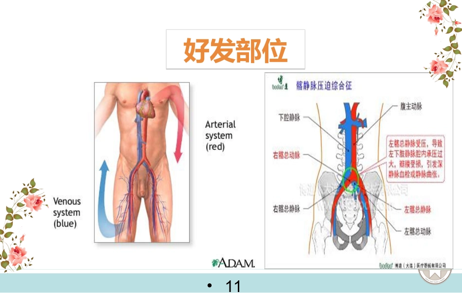 静脉血栓栓塞症的预防与护理_第11页