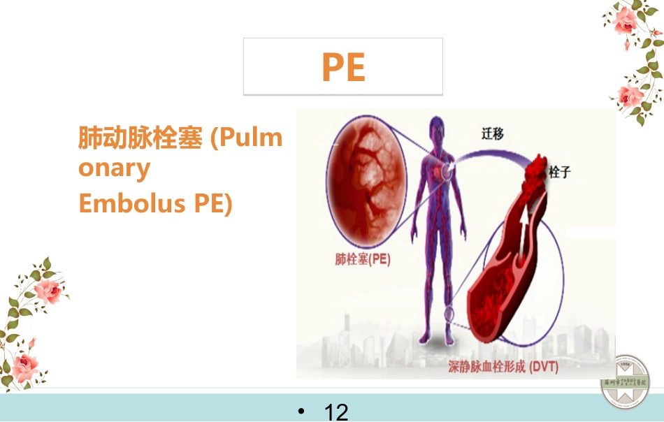 静脉血栓栓塞症的预防与护理_第12页