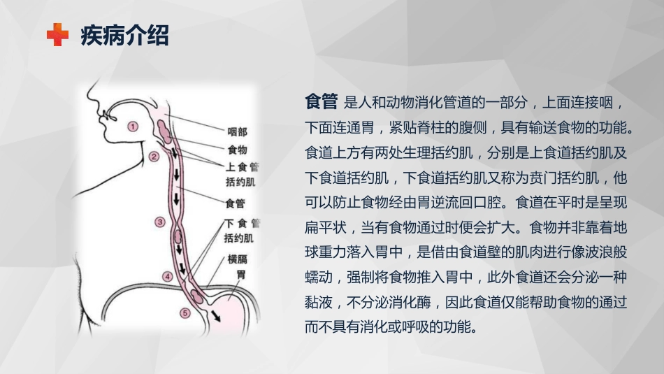 外科护理：食管癌的护理查房知识课件_第4页