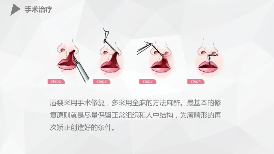 外科护理：幼儿唇裂的护理查房_第11页