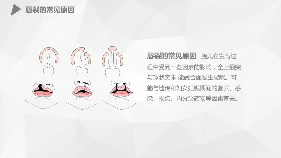 外科护理：幼儿唇裂的护理查房_第5页