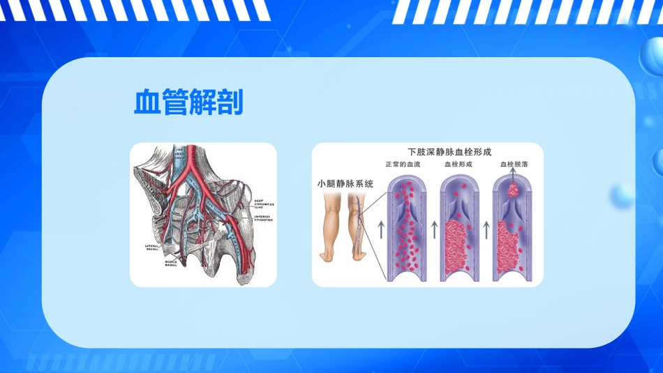 外科护理：下肢深静脉血栓的护理_第11页