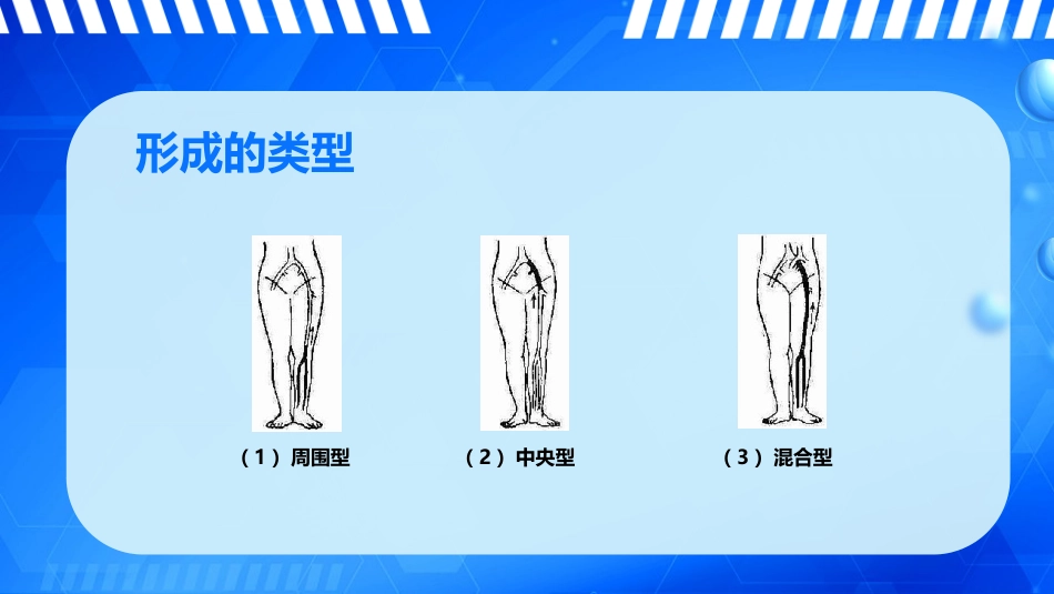 外科护理：下肢深静脉血栓的护理_第15页