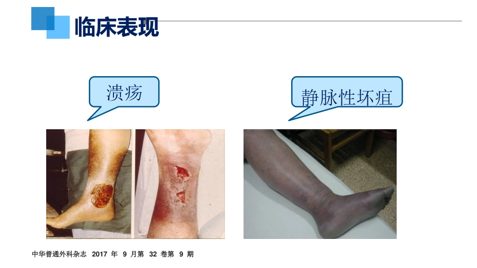 VTE的预防和护理ppt课件_第10页