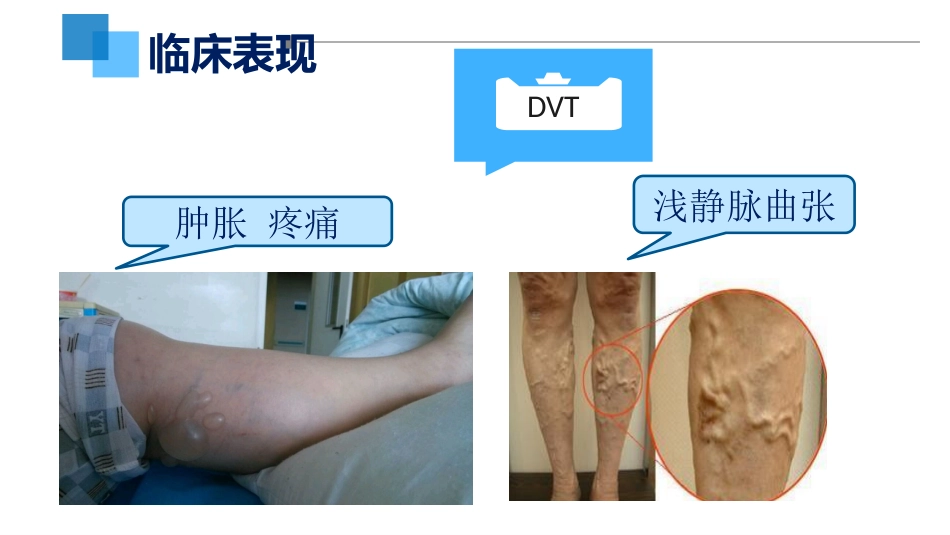 VTE的预防和护理ppt课件_第9页