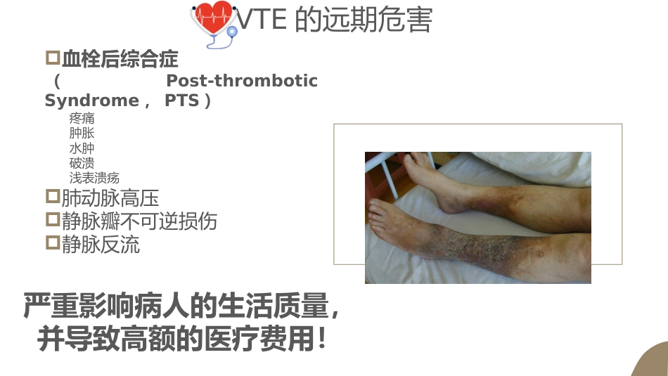 VTE的预防及护理课件ppt_第9页