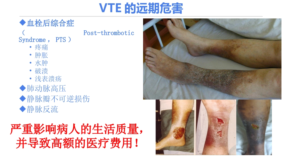 《住院患者静脉血栓栓塞症预防护理与管理专家共识》解读_第6页