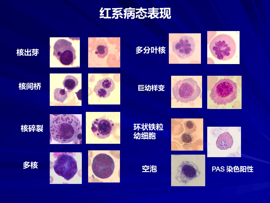 骨髓增生异常综合诊断与分型的专家共识_第14页