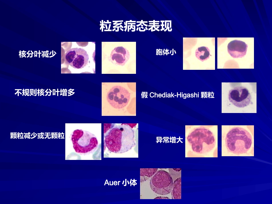 骨髓增生异常综合诊断与分型的专家共识_第15页