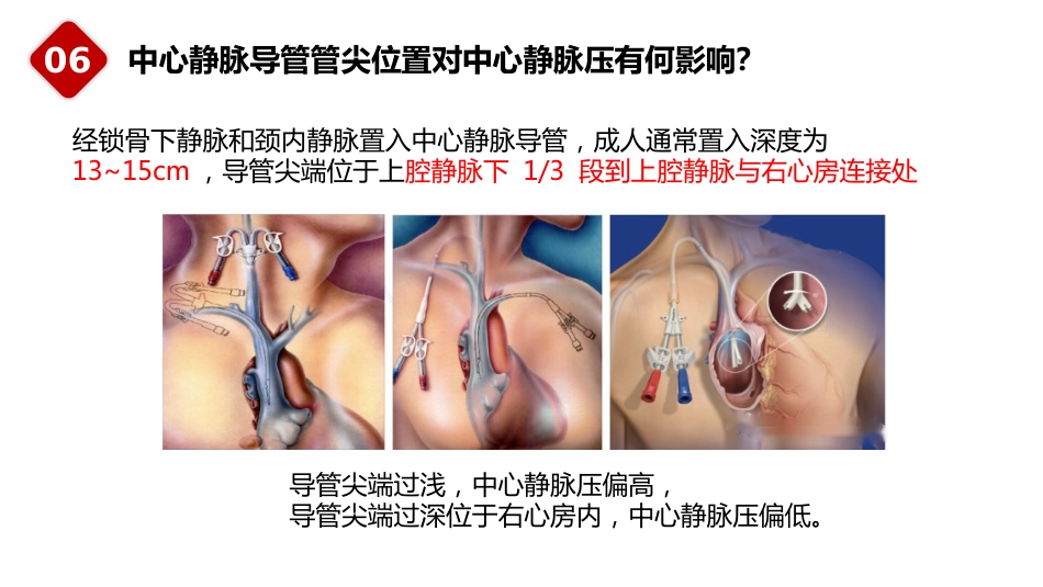 重症患者中心静脉导管管理中国专家共识(2022版)_第10页