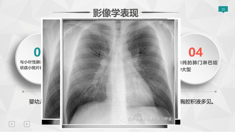 儿童肺炎支原体肺炎专家共识指南解读PPT精选课件_第15页
