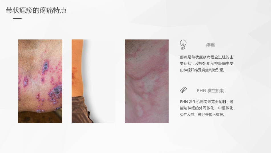 老年带状疱疹诊疗专家共识_第10页