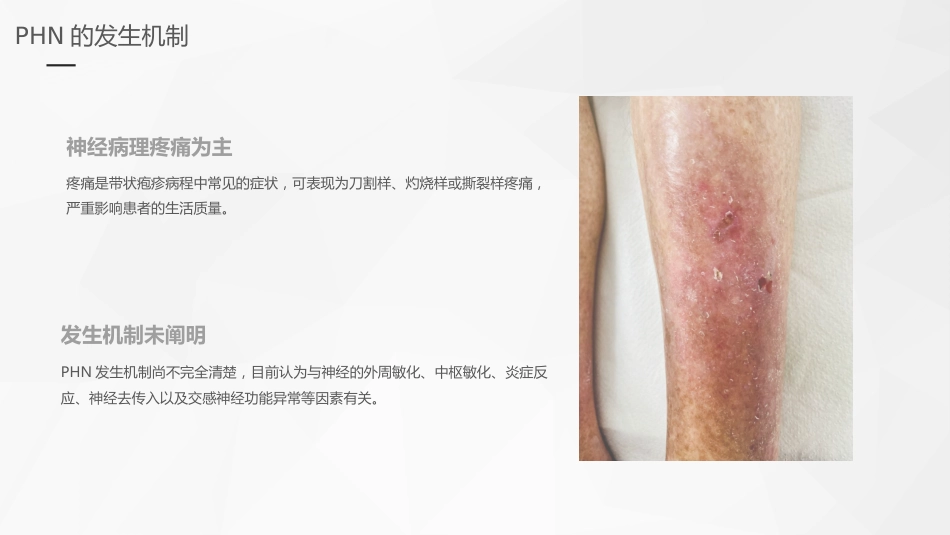 老年带状疱疹诊疗专家共识_第11页
