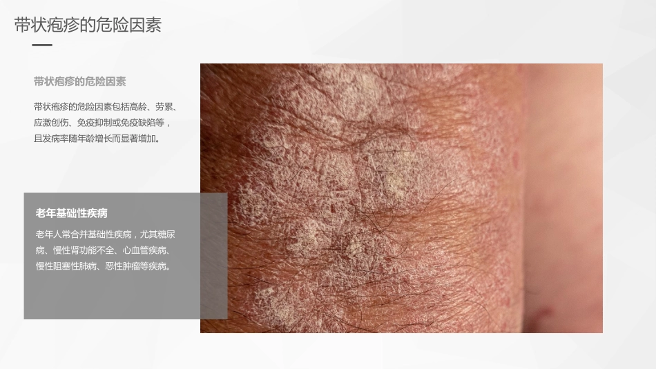 老年带状疱疹诊疗专家共识_第9页