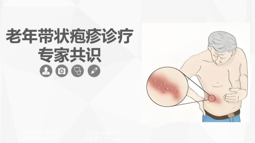 老年带状疱疹诊疗专家共识