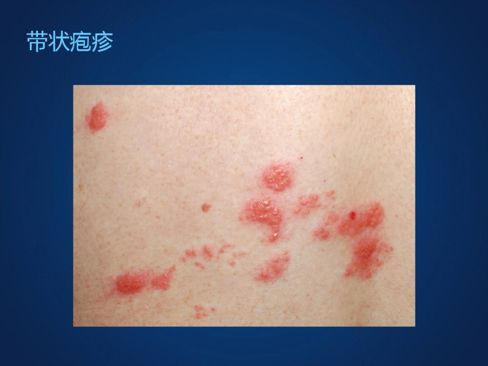 带状疱疹后神经痛诊疗中国专家共识_第3页