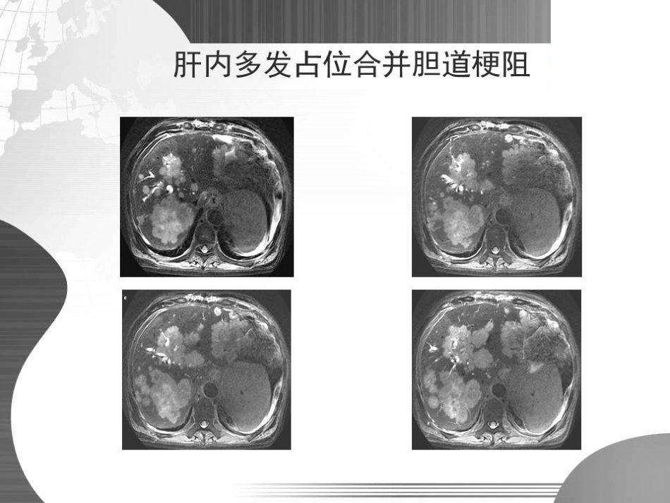 经皮经肝胆道引流(PTBD)专家共识的规范化解读_第6页
