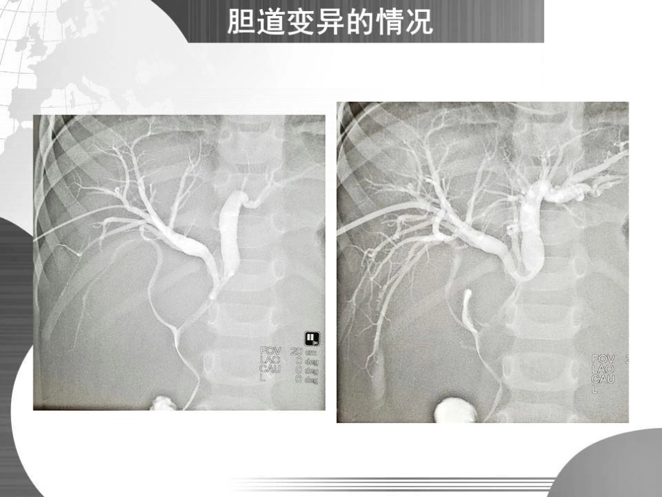 经皮经肝胆道引流(PTBD)专家共识的规范化解读_第7页